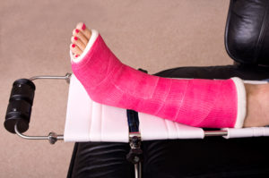 A leg with a hot pink cast on it.